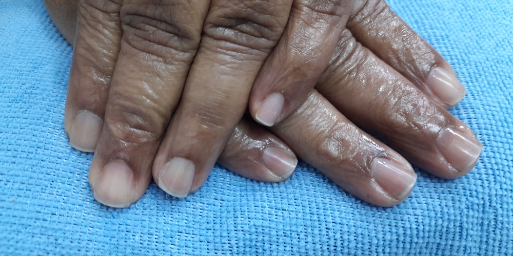img of Uñas acrílicas: Técnica Francesa en Reversa